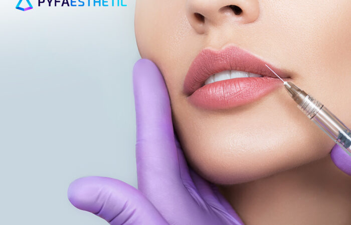 bagaimana cara mengatasi luka memar setelah filler? Berikut informasi selengkapnya.