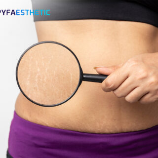 Simak informasi selengkapnya mengenai beragam perawatan untuk membantu menghilangkan selulit di artikel ini.