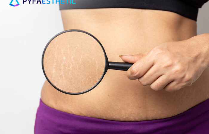 Simak informasi selengkapnya mengenai beragam perawatan untuk membantu menghilangkan selulit di artikel ini.