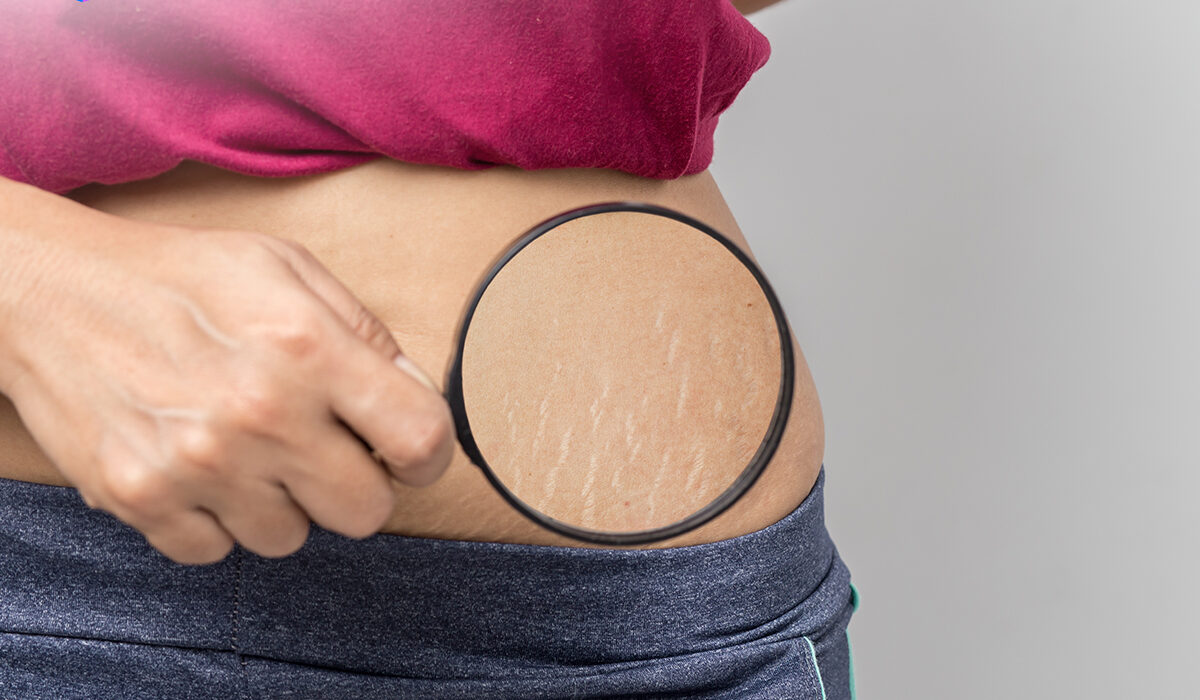 Kandungan Skincare untuk Menyamarkan Stretch Mark