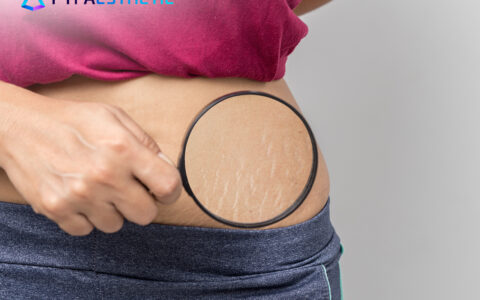Kandungan Skincare untuk Menyamarkan Stretch Mark
