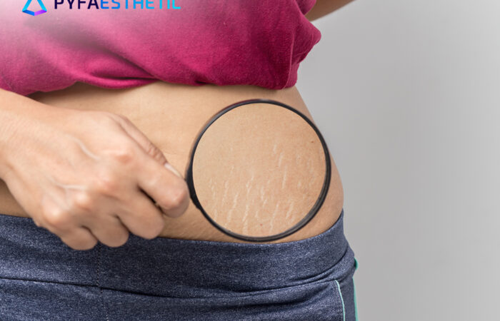 Kandungan Skincare untuk Menyamarkan Stretch Mark