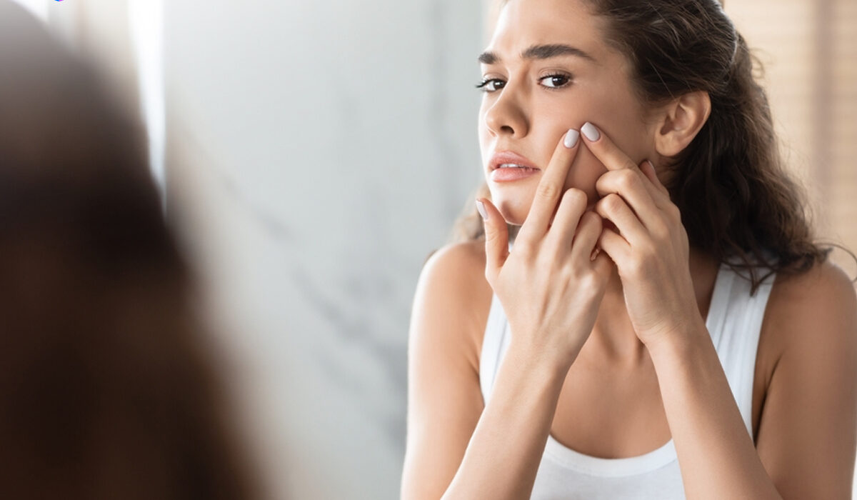 Mengenal Acne Prone Skin, Penyebab, dan Cara Mengatasinya