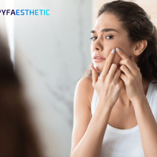 Mengenal Acne Prone Skin, Penyebab, dan Cara Mengatasinya