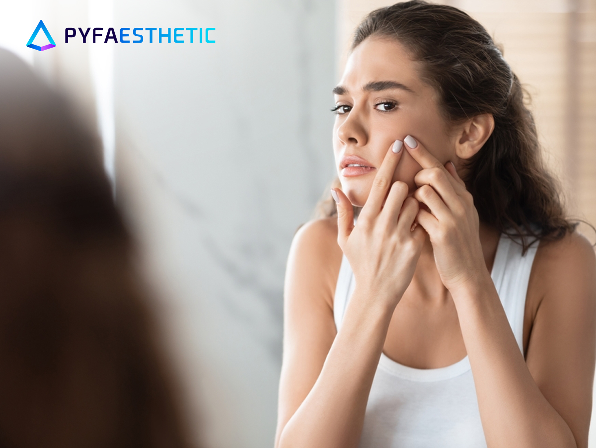 Mengenal Acne Prone Skin, Penyebab, dan Cara Mengatasinya