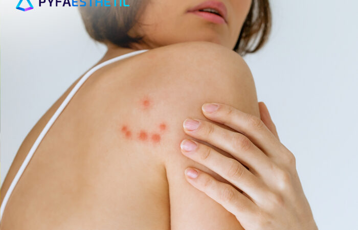 Manfaat Eksfoliasi untuk Mengatasi Jerawat Punggung