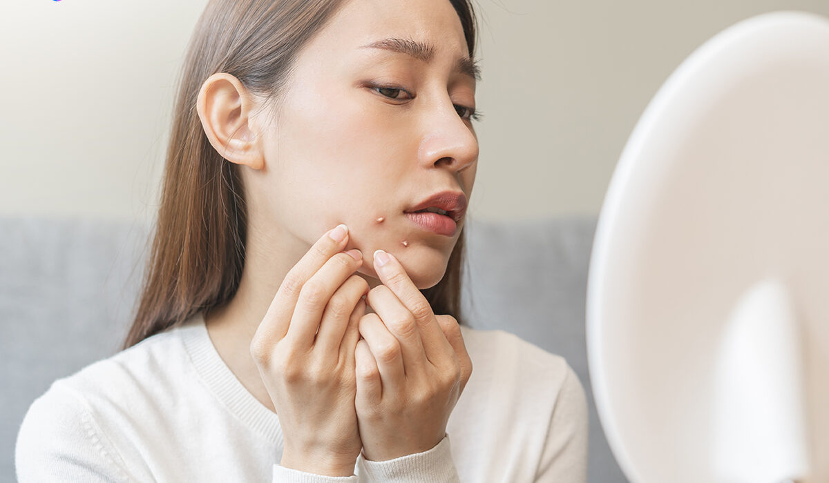 Perbedaan Jerawat Hormonal dan Jerawat Bakteri