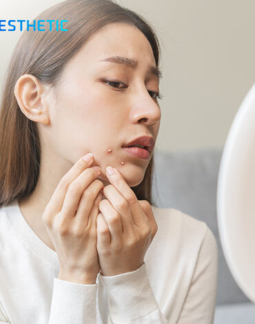 Perbedaan Jerawat Hormonal dan Jerawat Bakteri