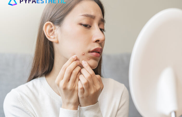 Perbedaan Jerawat Hormonal dan Jerawat Bakteri