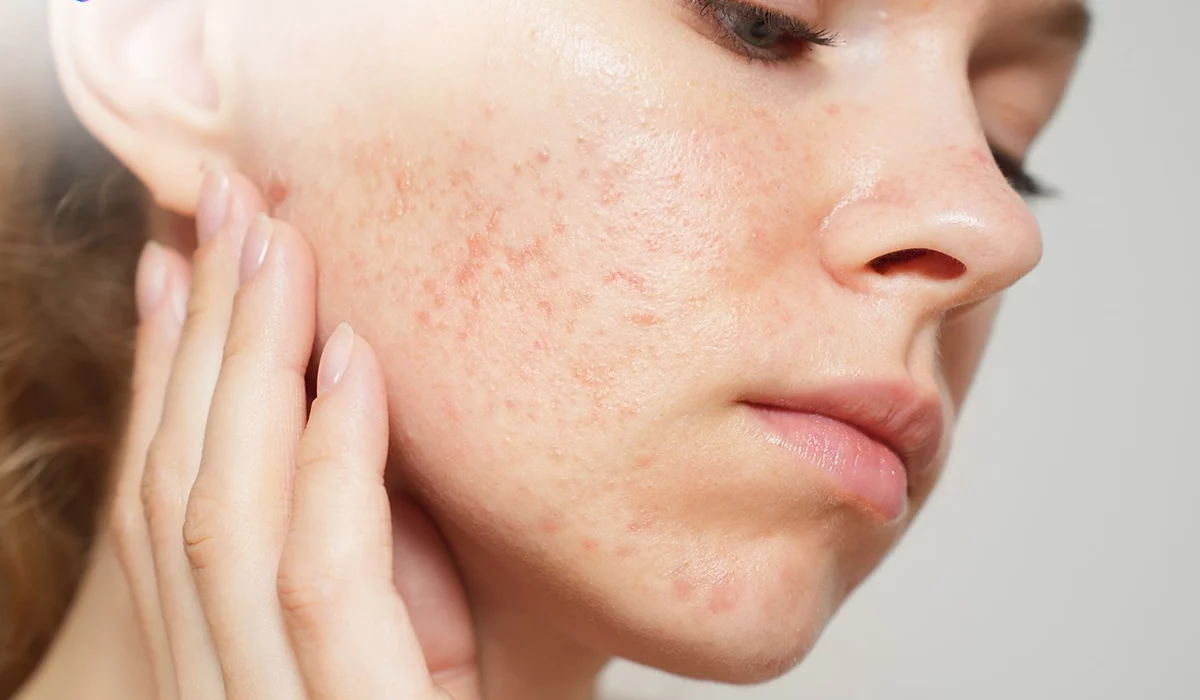 Cara Memilih Skincare untuk Kulit Berminyak dan Rentan Jerawat