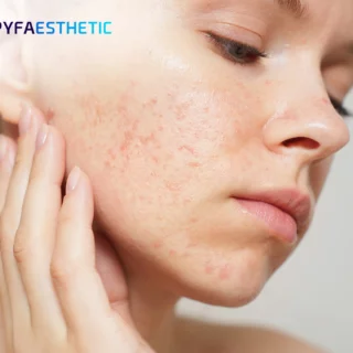 Cara Memilih Skincare untuk Kulit Berminyak dan Rentan Jerawat