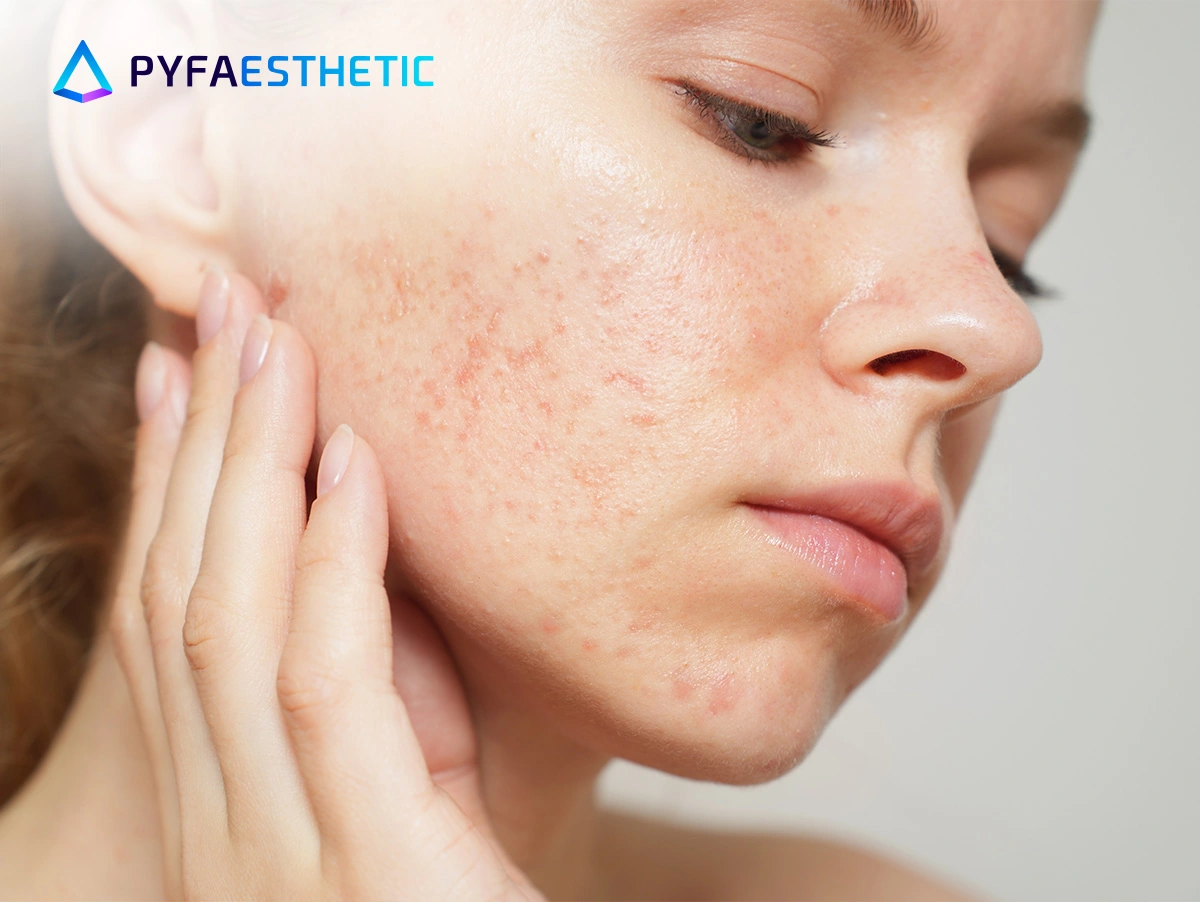 Cara Memilih Skincare untuk Kulit Berminyak dan Rentan Jerawat