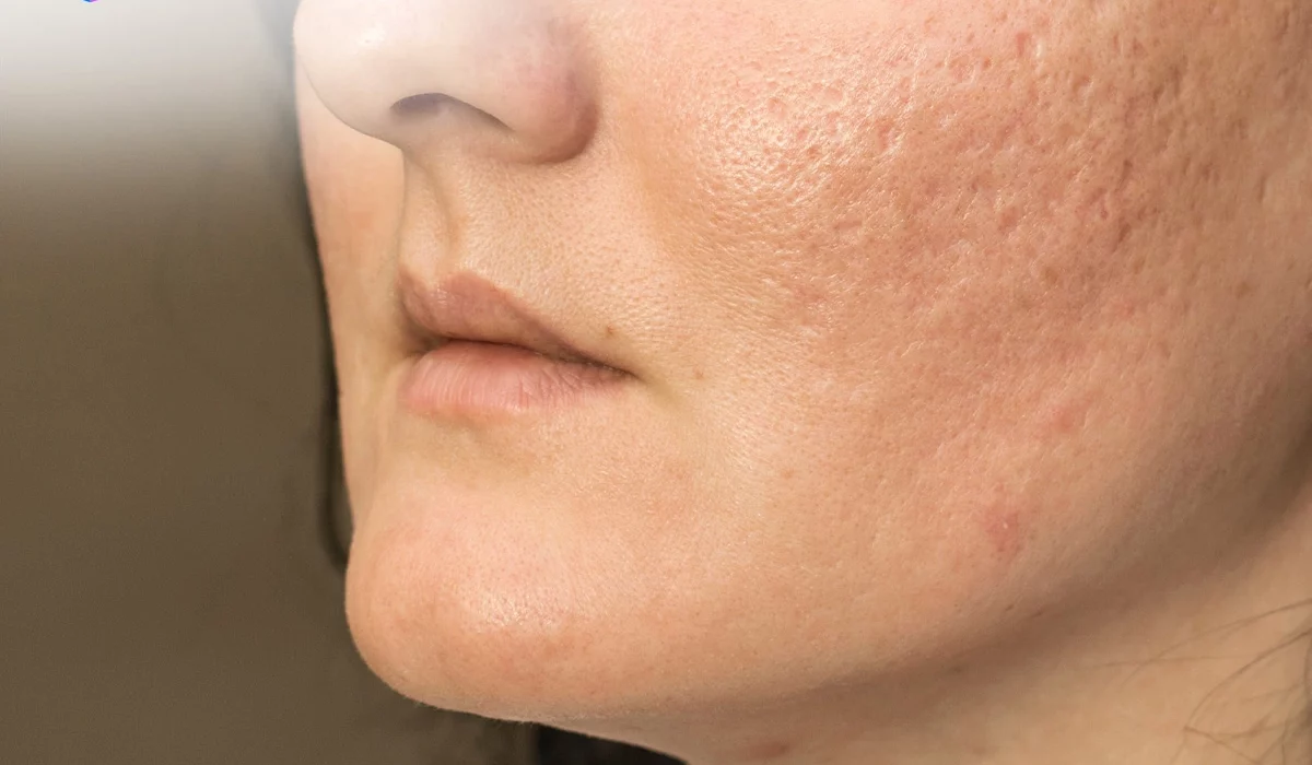 Mengapa Acne Scars Butuh Perawatan Lebih dari Sekadar Krim Biasa