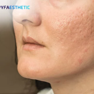 Mengapa Acne Scars Butuh Perawatan Lebih dari Sekadar Krim Biasa