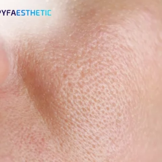 Wajah Mulus Tanpa Filter - Rahasia Memperbaiki Tampilan Pori-Pori dengan GwangFeel