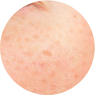 Niacinamide