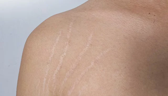Cara Menyamarkan Tampilan Stretch Mark dengan Cepat