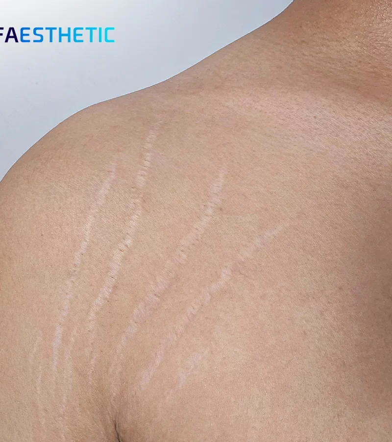 Cara Menyamarkan Tampilan Stretch Mark dengan Cepat