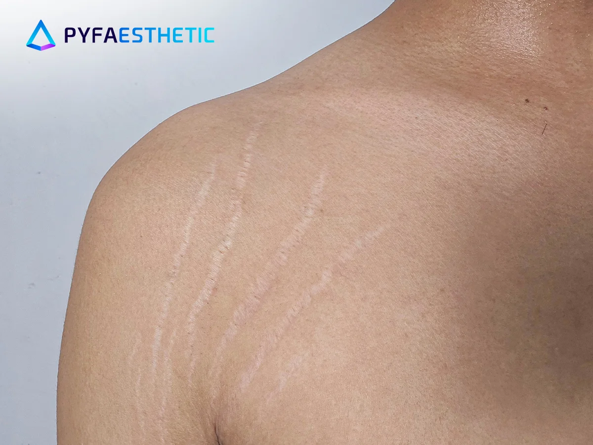 Cara Menyamarkan Tampilan Stretch Mark dengan Cepat